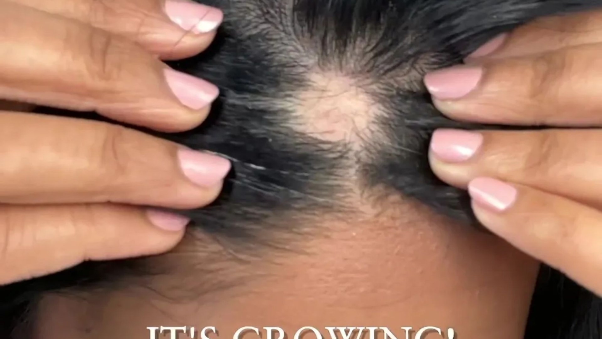 Isuffered from bald patches so tried a 3p hack to get my hair to grow back – it really stinks but is so effective [Video]