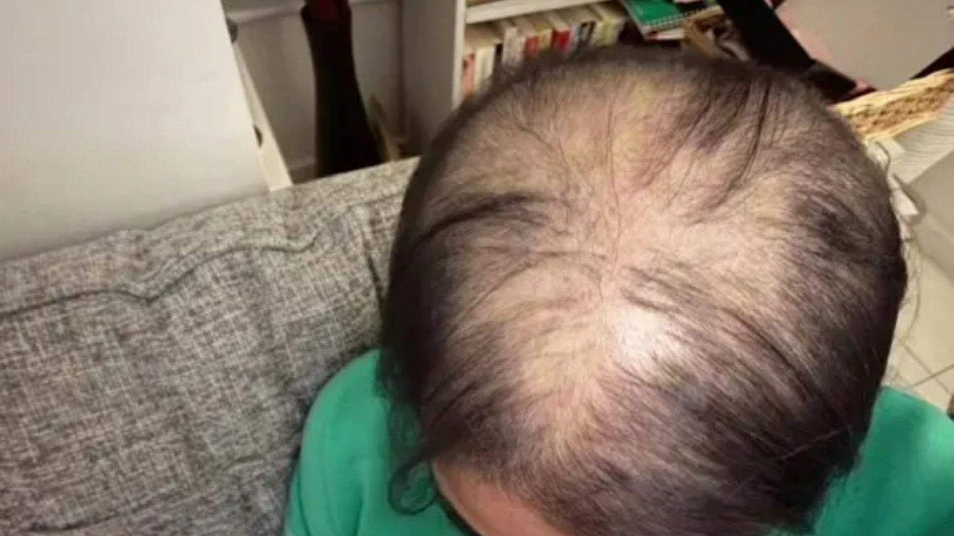 I had a huge bald spot but fixed it in 6 weeks – people beg for my secrets & my free tip is life-changing [Video]