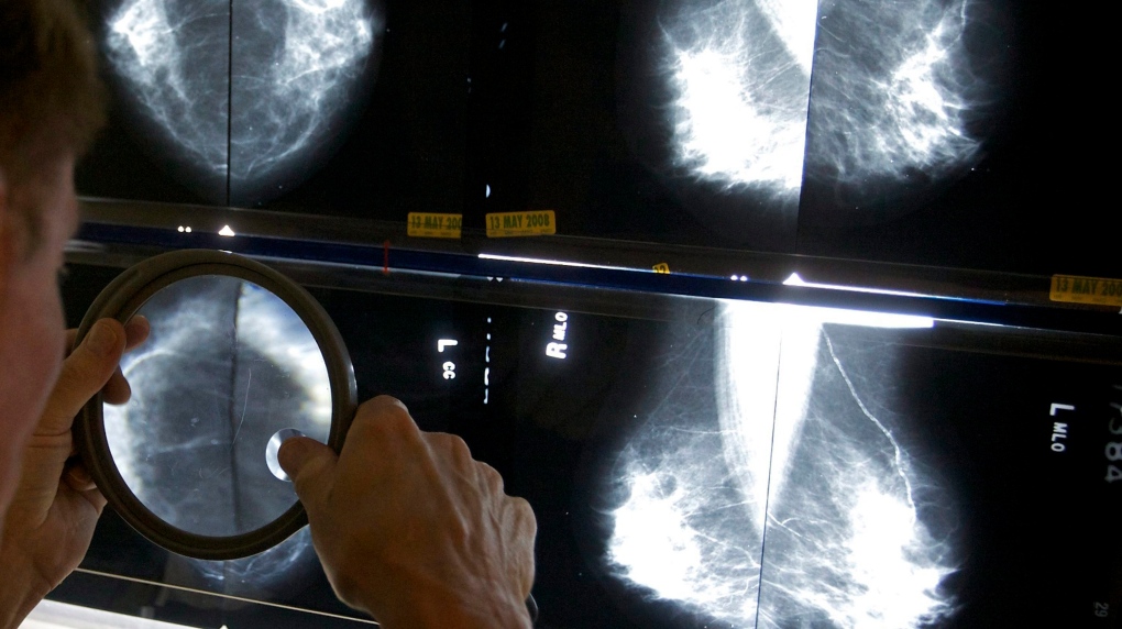 Breast cancer screening should start at 40: Canadian Cancer Society [Video]
