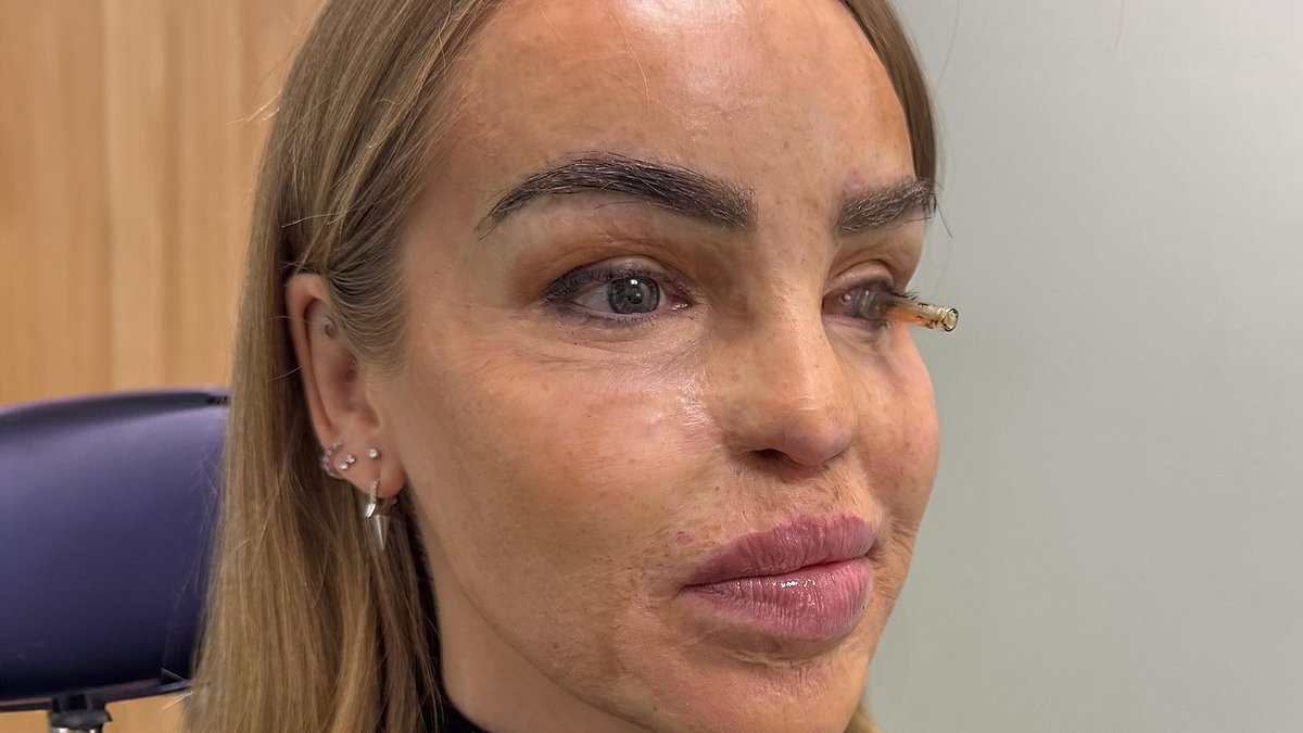 Katie Piper shares emotional health update afterundergoing eye surgery: 